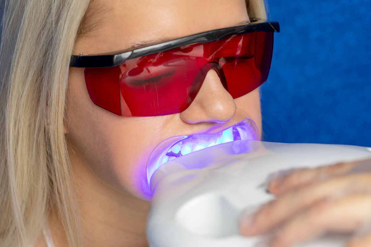 Tutto quello che c'è da sapere sullo sbiancamento professionale dei denti dal dentista