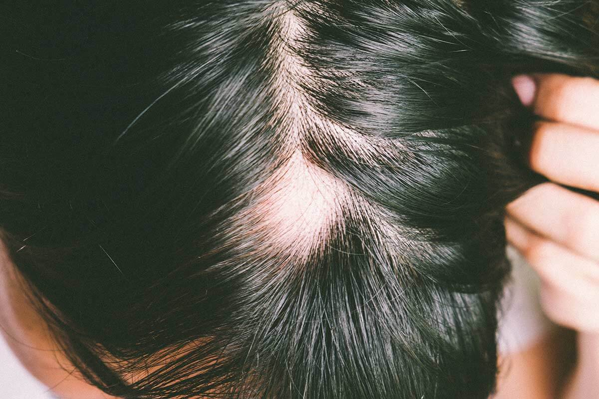 Alopecia Androgenetica