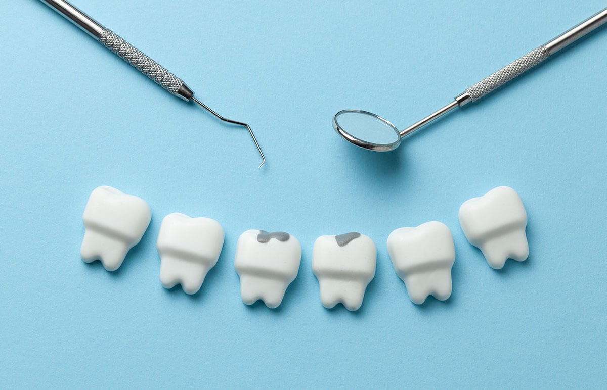 Carie Ai Denti Cosa Sono, Come Si Formano