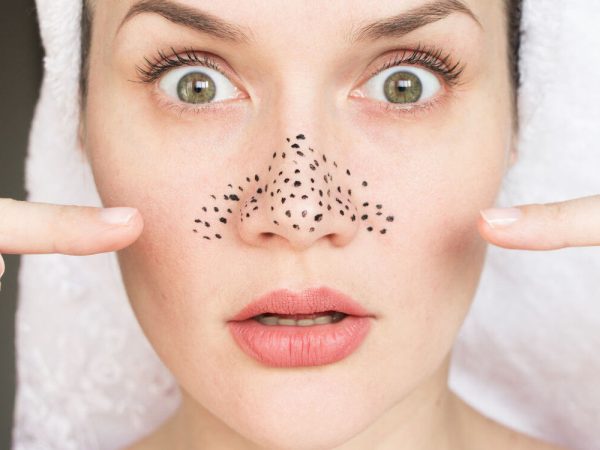 Punti neri cosa sono e come si formano